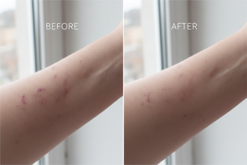 Before and after Rose HP Oil - skin with scars versus reduced scars and smooth skin