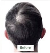 Before — hair thinning at the crown before using PURE BÉNI Hair Growth Duo