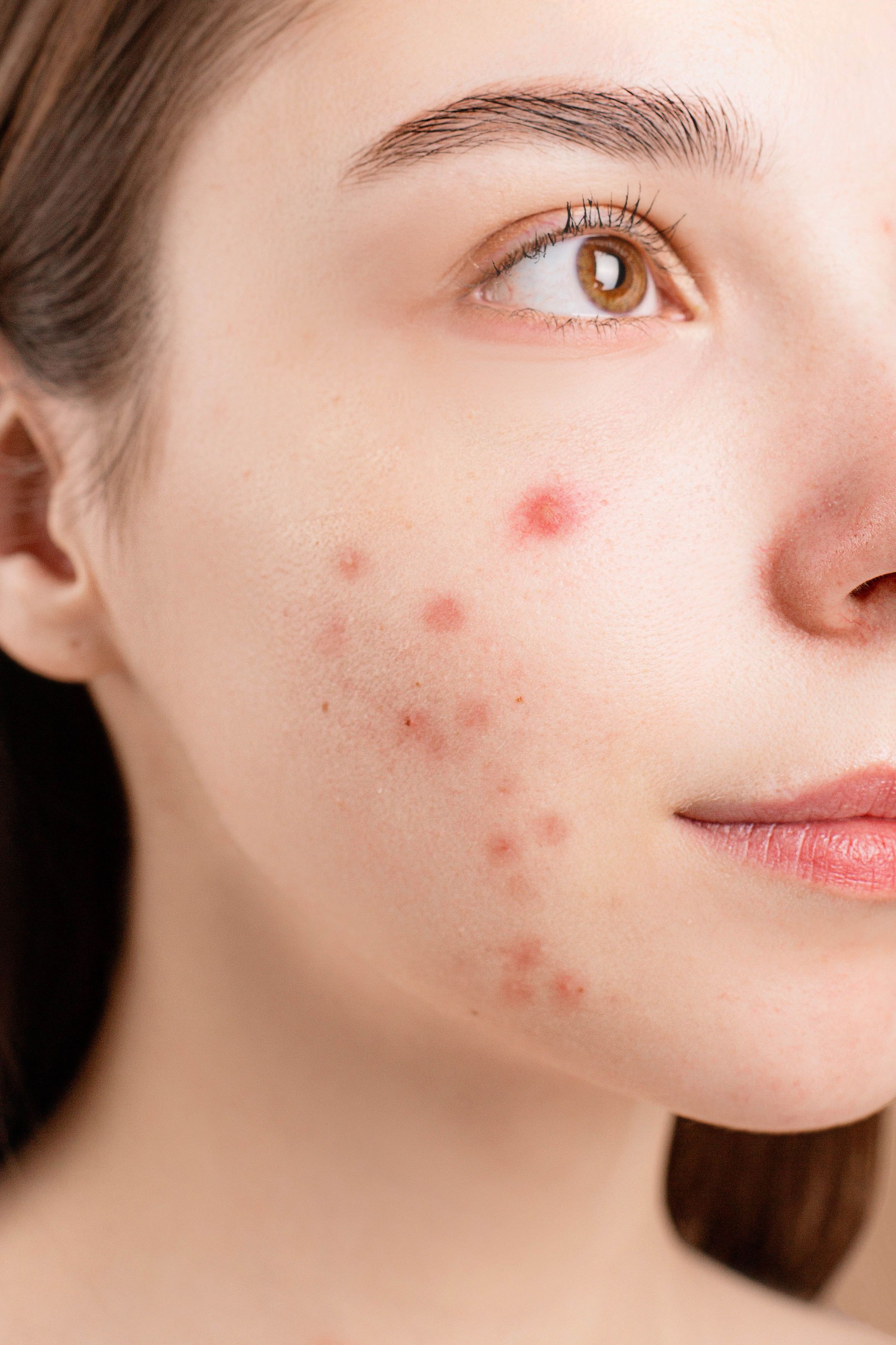 Young woman with acne — rosehip oil anti-inflammatory treatment