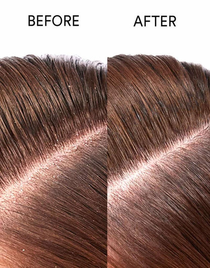 Dry scalp treatment results with PURE BÉNI botanical hair oil — nourished and hydrated scalp
