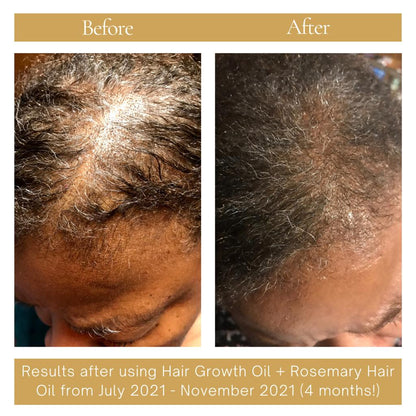 Thinning edges before and after treatment with PURE BÉNI Rosemary & Castor Hair Oil
