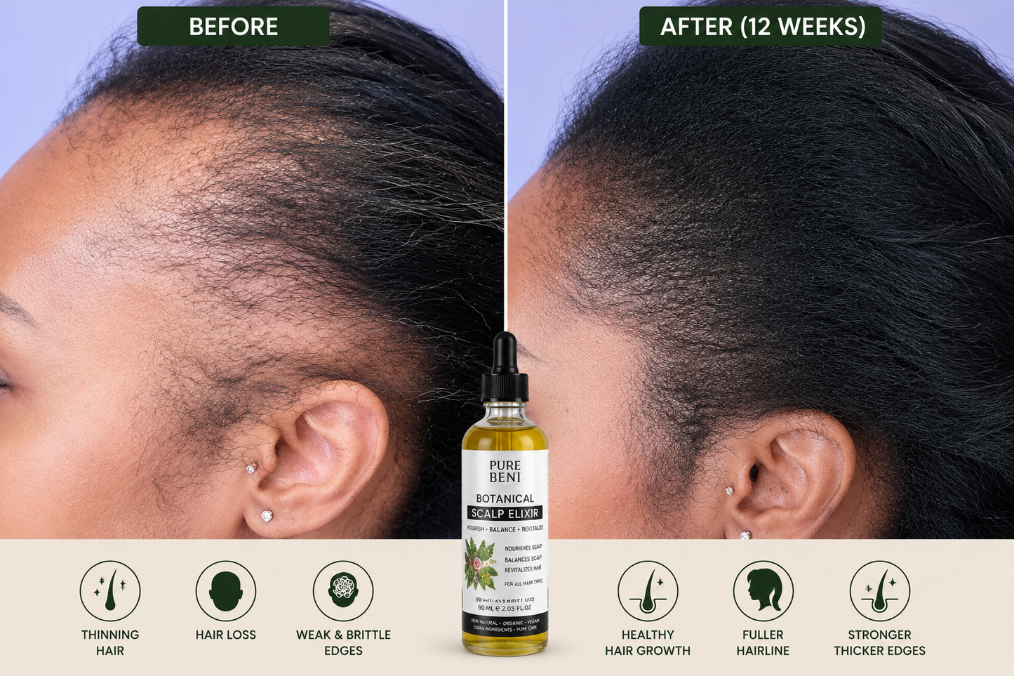 Before and after comparison showing improved hair growth and fuller edges after using PURE BENI natural hair oil. The left image shows thinning edges and hair loss, while the right image shows thicker, healthier hair growth around the hairline.