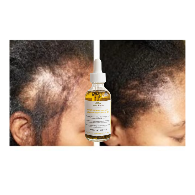 "PURE BÉNI Hair Growth Oil before and after comparison - visible hair regrowth and thicker hairline after treatment"