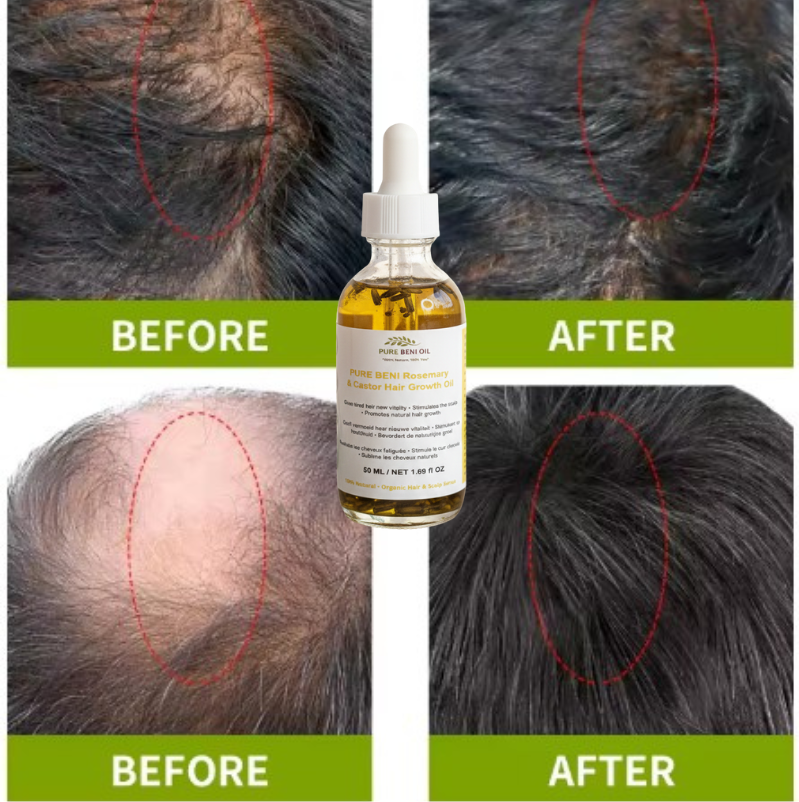  "Before and after hair growth transformation using PURE BÉNI Oil - dramatic improvement in hair density and scalp coverage"