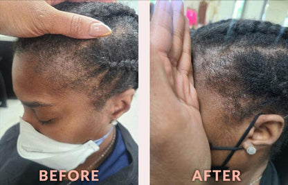 Before and after hairline restoration using PURE BÉNI natural hair growth serum