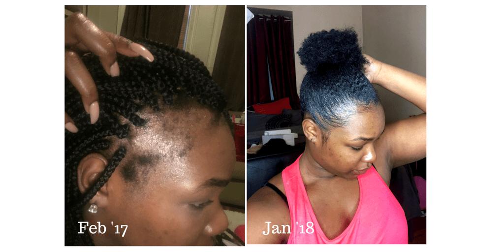 Hair growth progress Month 1 vs Month 12 with PURE BÉNI botanical scalp oil
