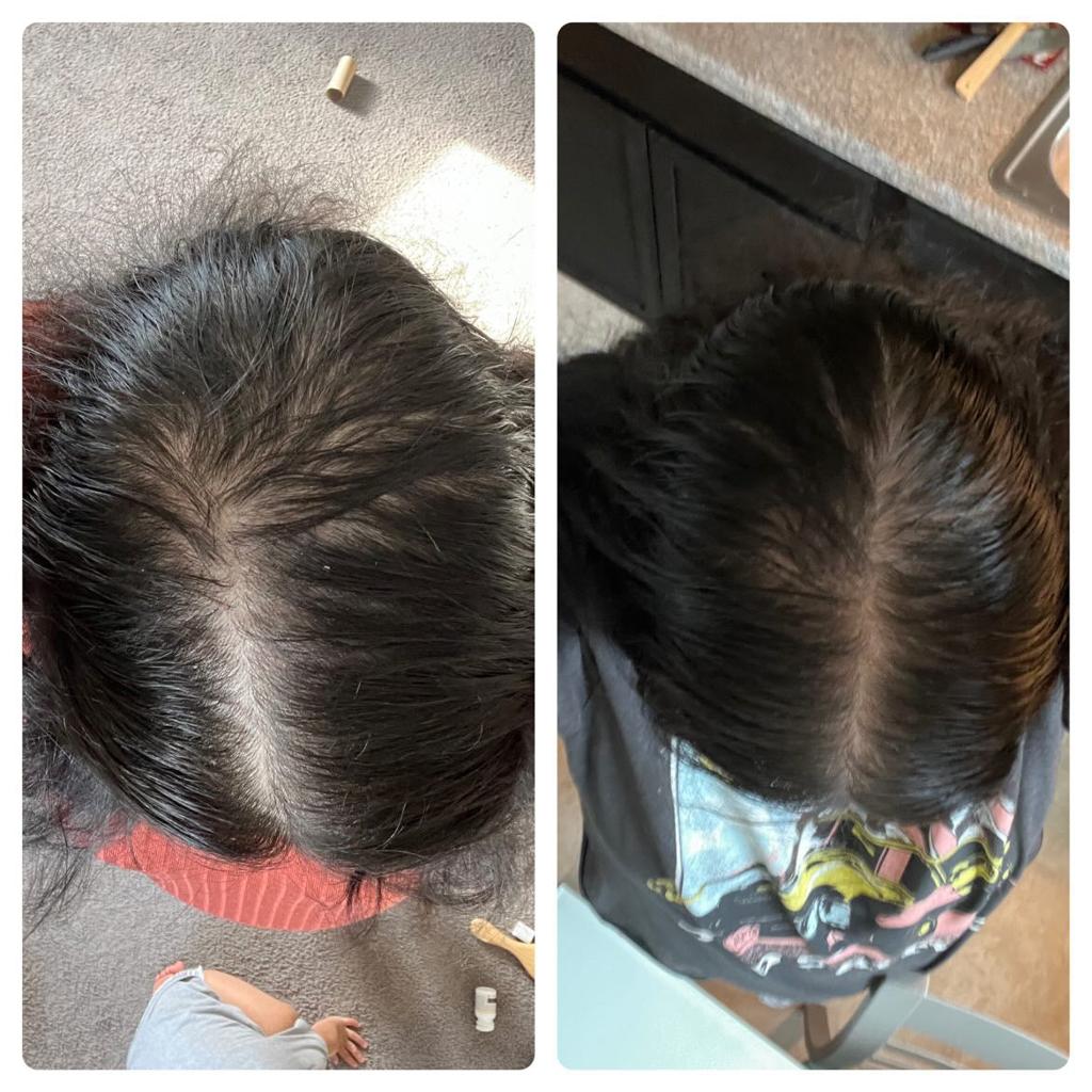 Crown hair thinning before and after — fuller, denser hair with PURE BÉNI growth oil