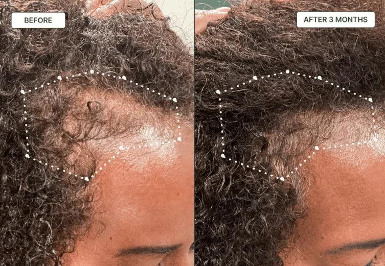 Before and after crown thinning recovery — visible hair regrowth with PURE BÉNI oil