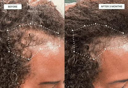 Before and after crown thinning recovery — visible hair regrowth with PURE BÉNI oil