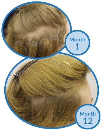 Before and after crown thinning recovery — visible hair regrowth with PURE BÉNI oil