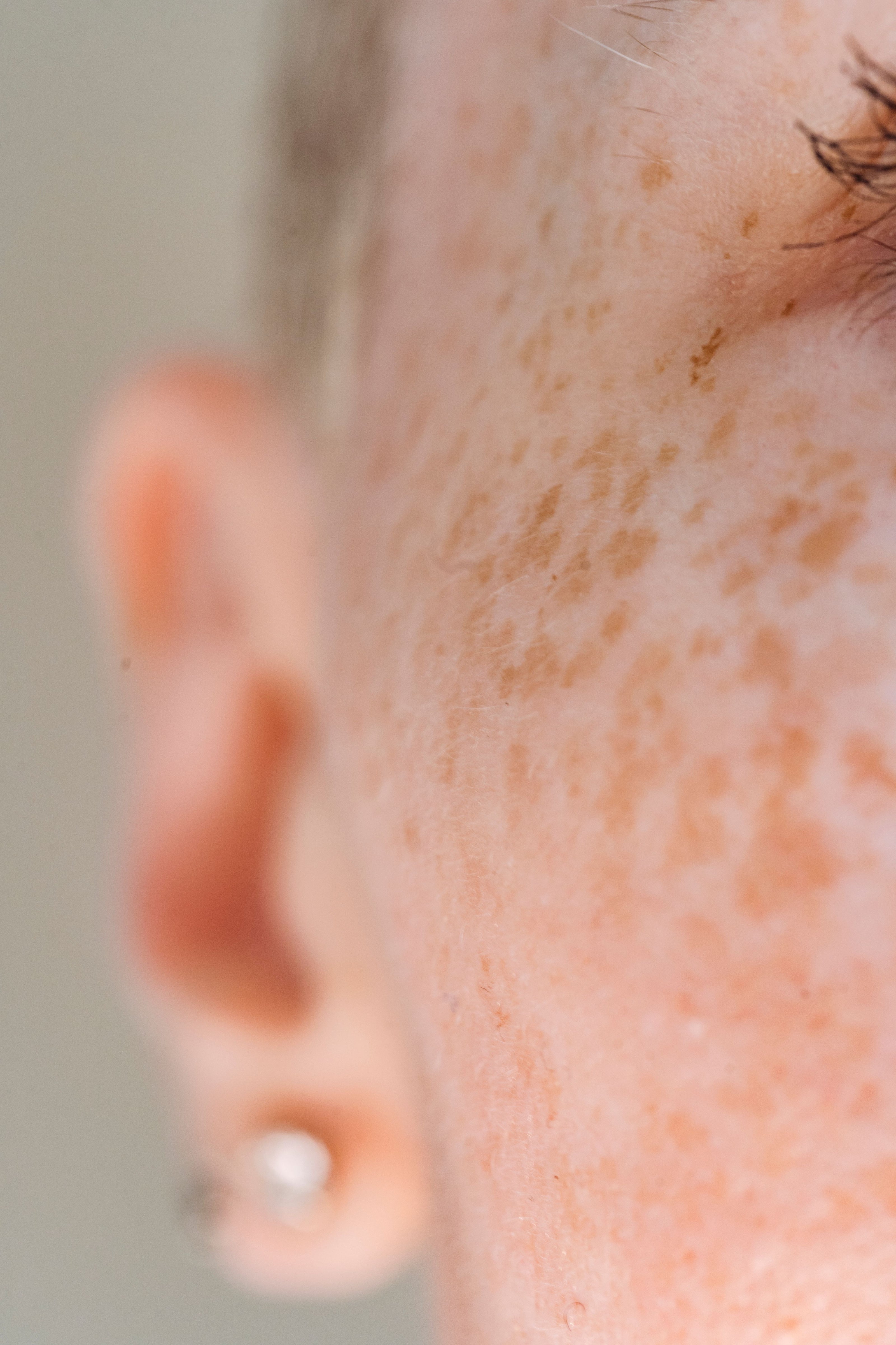 Uneven skin tone — rosehip oil for radiant complexion
