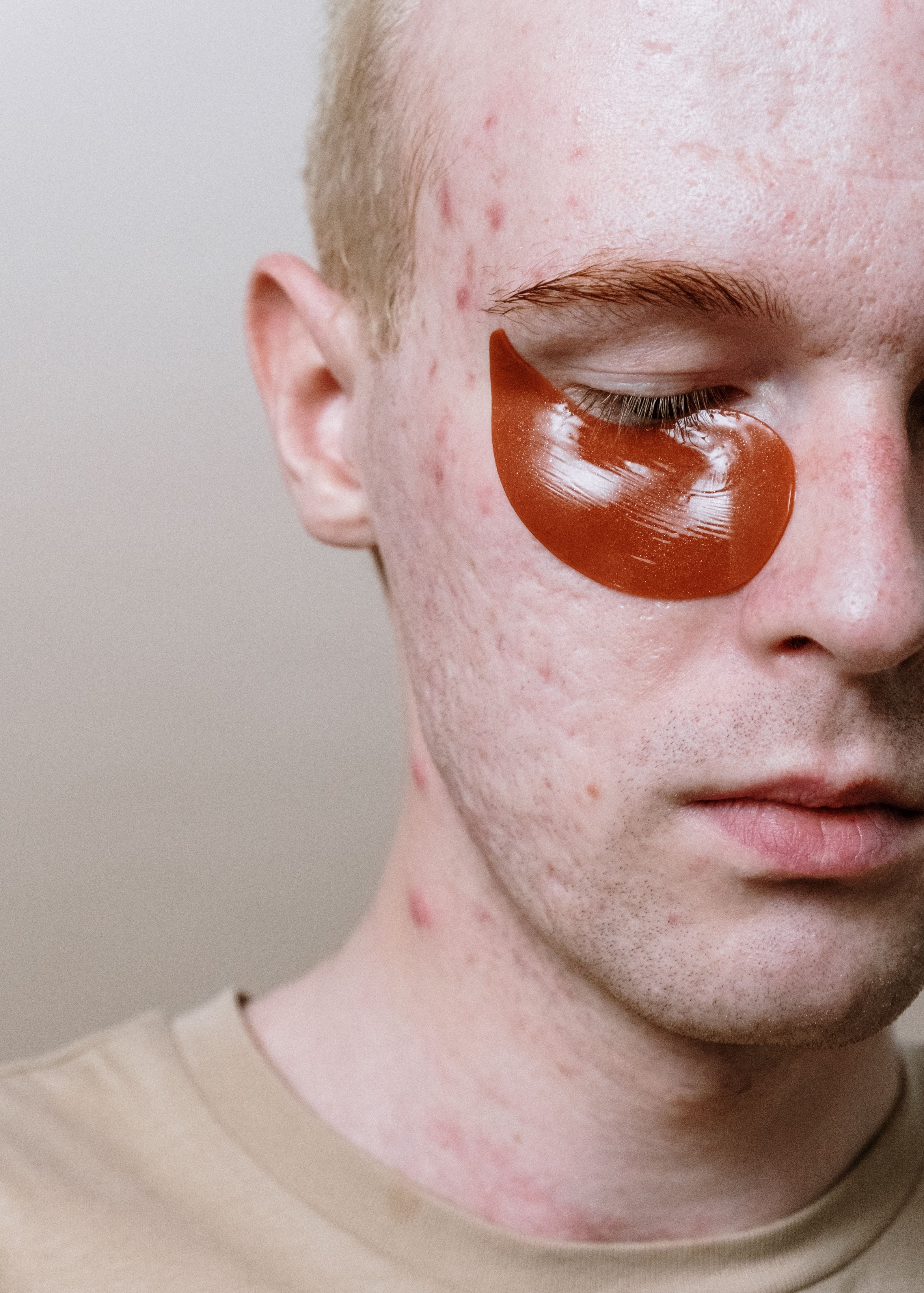 Boy with acne scars — rosehip oil for skin repair
