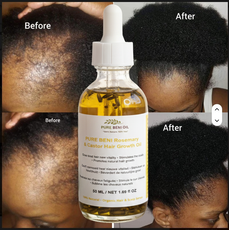 "PURE BÉNI Rosemary & Castor Hair Growth Oil - before and after results showing hair regrowth on children with thinning patches"